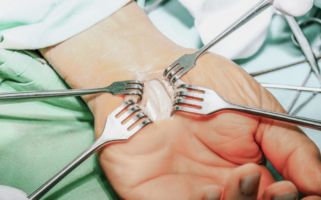 carpal tunnel procedure