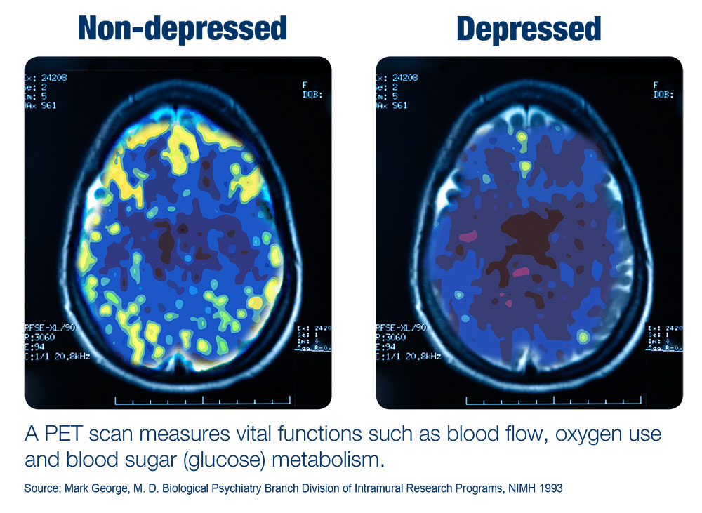 Non-depressed vs depressed PET scan of brains